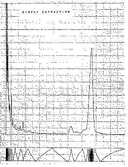 Full size image: 66 kB, 3. Gas chromatogram of trimethylsilyl derivative of LSD after direct extraction with chloroform-methanol (9:1)