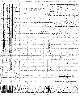 Full size image: 70 kB, 4. Gas chromatogram of trimethylsilyl derivative of LSD after direct extraction with chloroform-methanol (9:1), sugar bands in early portion of chromatogram